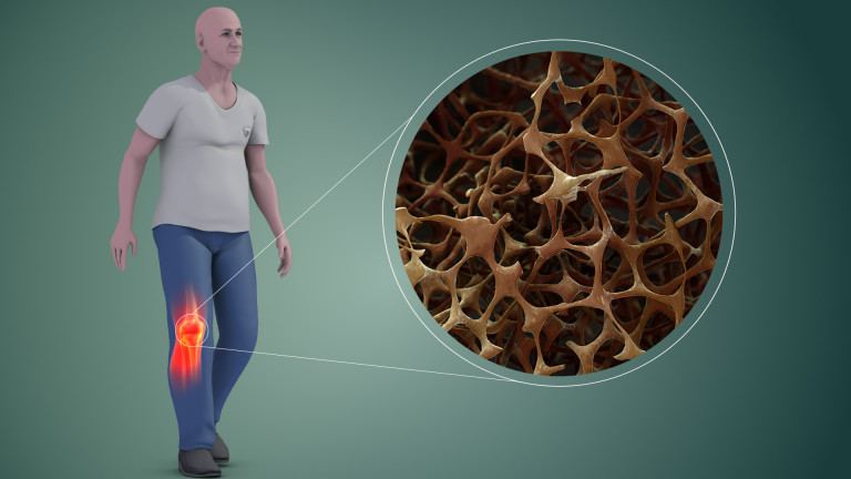 Óránként tíz törés: a csontritkulás gyakori betegség, de megelőzhető és kezelhető